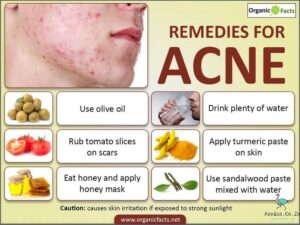 1. How to Use Home Remedies for Acne Treatment